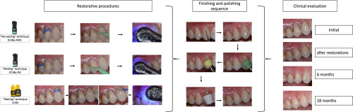 Prolonged Application Time Effects on Universal Adhesives in Non-Carious Cervical Lesions: An 18-Month Split Mouth Randomized Clinical Trial