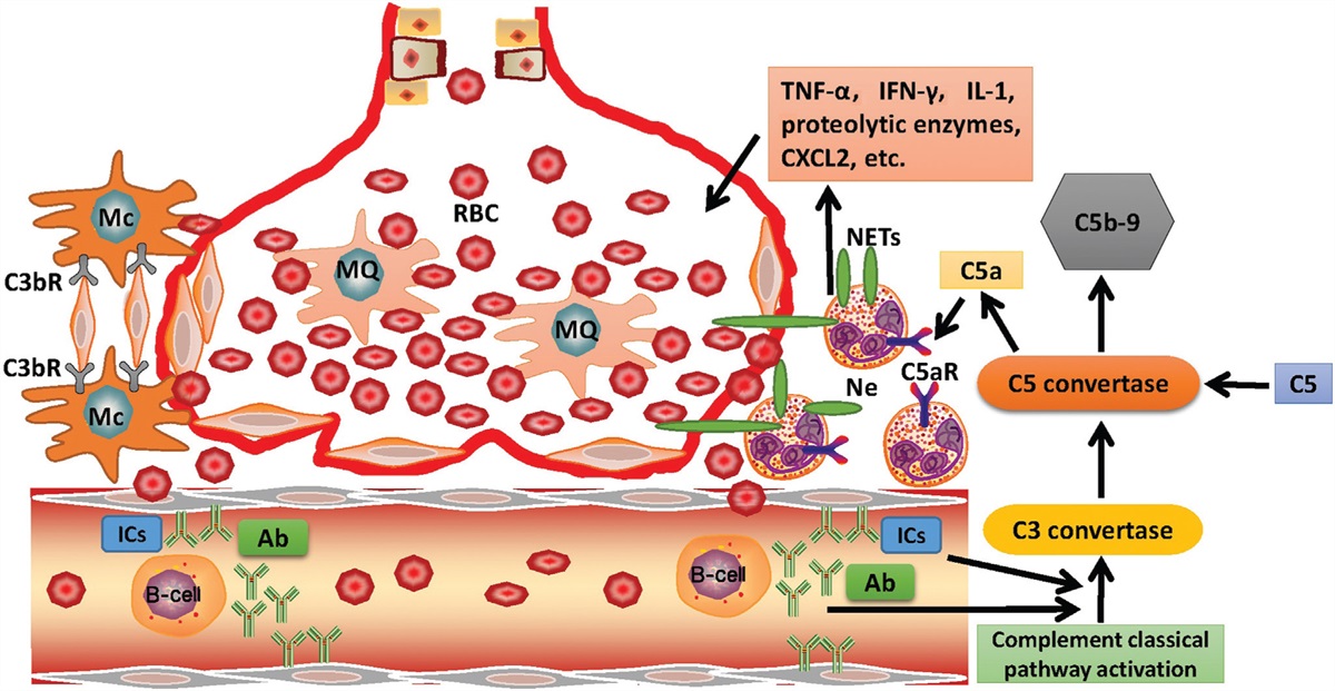Systemic lupus erythematosus with diffuse alveolar hemorrhage