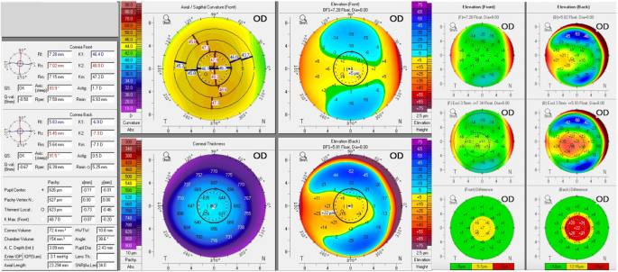 False positive Belin-Ambrosio enhanced ectasia screening in small white-to-white diameter