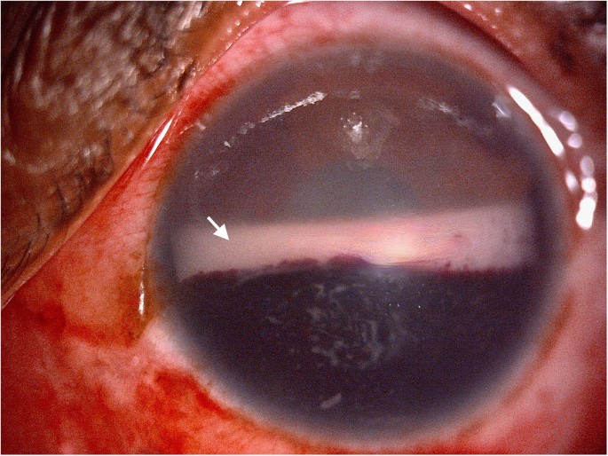 Dual-layered hyphema and pseudohypopyon: unusual presentation of leukaemia