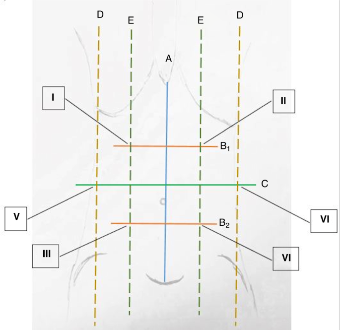 Long-term motor activity, cardiopulmonary performance and quality of life in abdominal wall defect patients