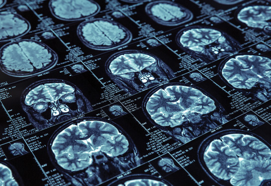 Higher conscientiousness linked to less risk of dementia diagnosis