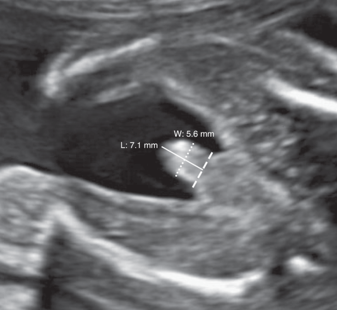 Prenatal phthalate exposure and fetal penile length and width