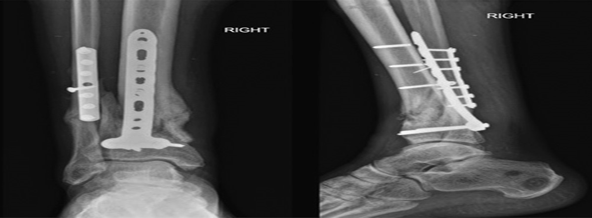 Intramedullary Delivery of Autologous Bone Graft to Long Bone Defects Using Reamer Irrigator Aspirator 2 System: Technical Trick
