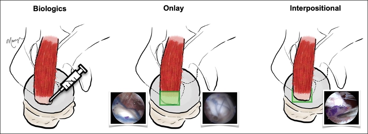 Indications and Technique: Rotator Cuff Repair Augmentation