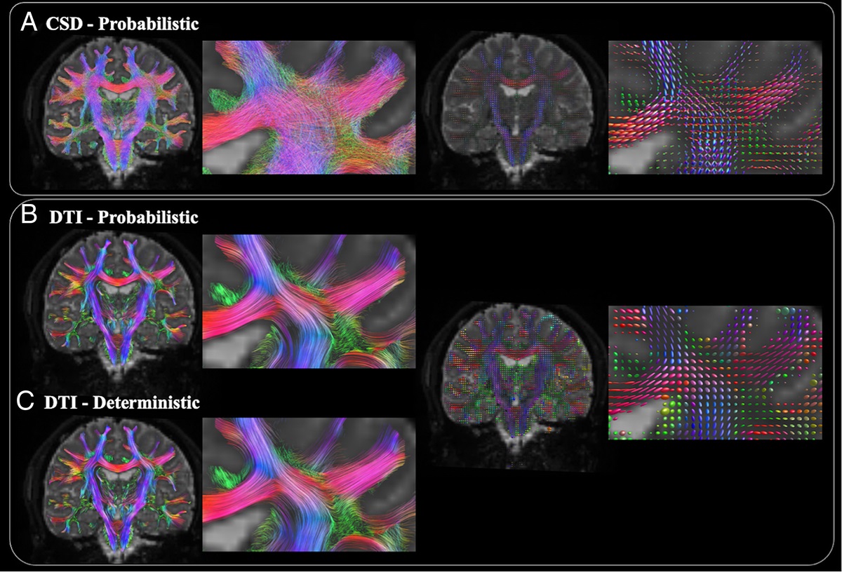 Advancements in Diffusion MRI Tractography for Neurosurgery