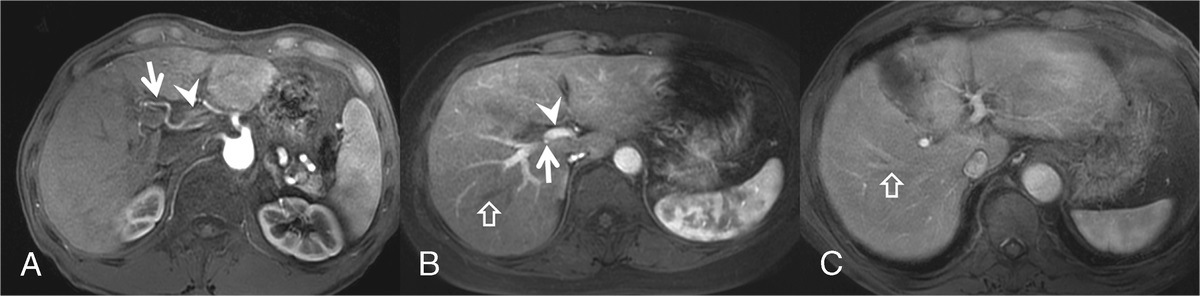 Gadoxetic Acid–Enhanced Liver MRI: Everything You Need to Know