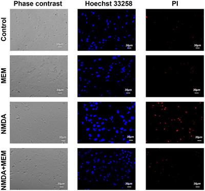 Memantine protects the cultured rat hippocampal neurons treated by NMDA and amyloid β1–42