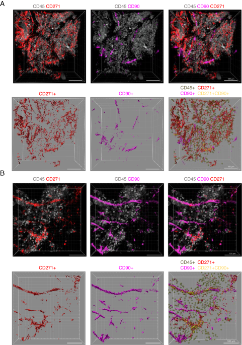Profound sympathetic neuropathy in the bone marrow of patients with acute myeloid leukemia