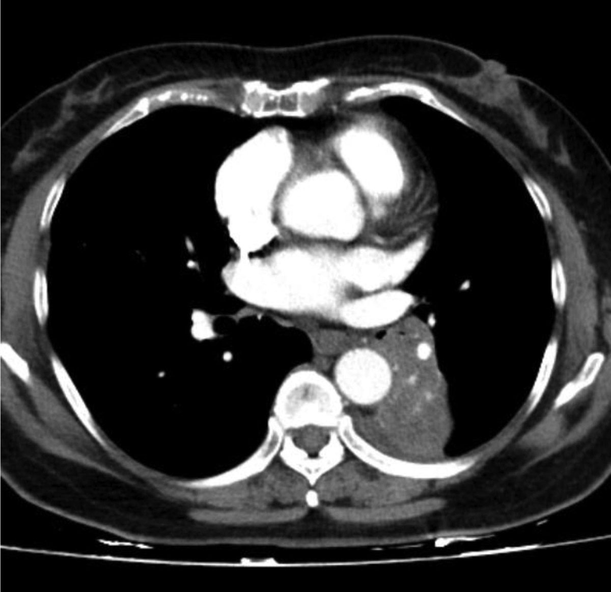 Analysis of clinical features of 7 cases of primary pleomorphic adenoma of lower respiratory tract and review of literature