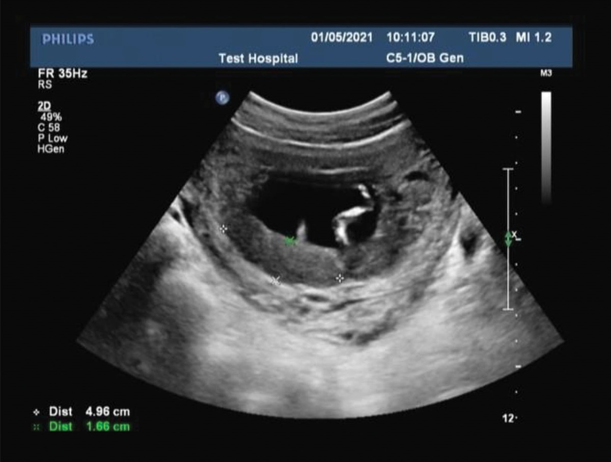 Sanji Peiyuan decoction combined with dydrogesterone in the treatment of massive subchorionic hematoma: A case report