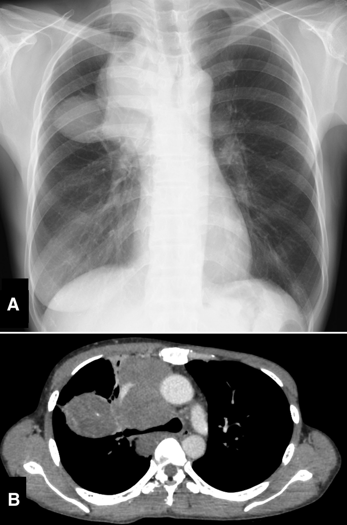 Sequential treatments with TRK inhibitors in a patient with NTRK fusion-positive sarcoma: A case report