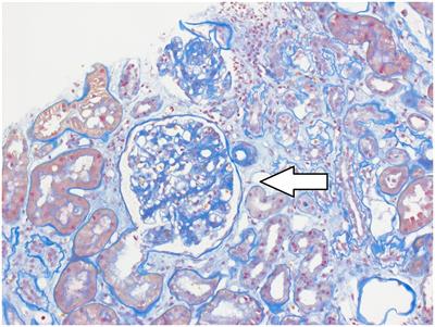 Renal failure following insulin purging in atypical anorexia nervosa and type 1 diabetes mellitus