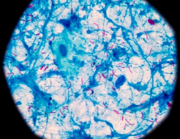 Natural compound activates macrophages to fight resistant tuberculosis bacteria