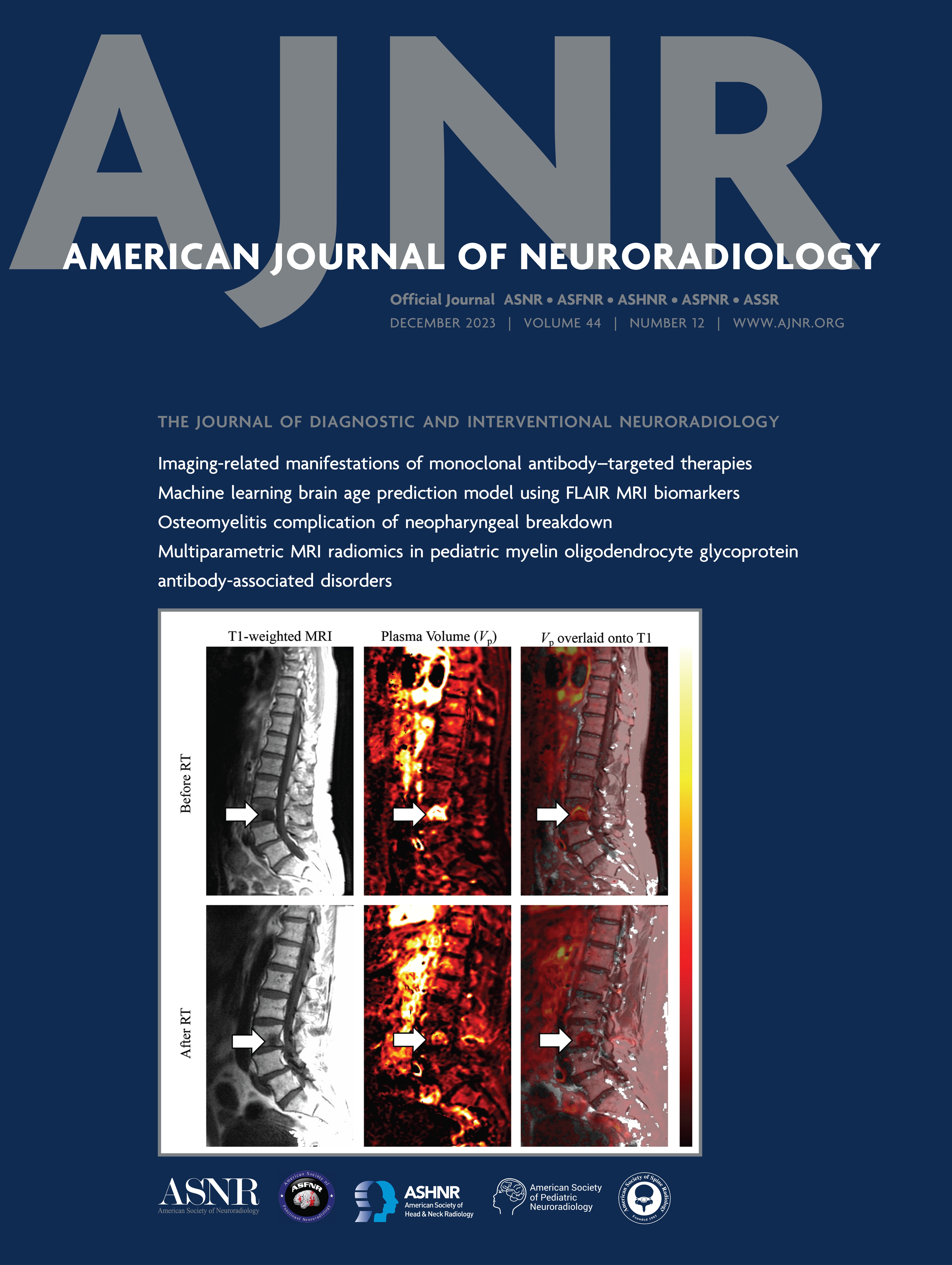 Automated Determination of the H3 K27-Altered Status in Spinal Cord Diffuse Midline Glioma by Radiomics Based on T2-Weighted MR Images [SPINE IMAGING AND SPINE IMAGE-GUIDED INTERVENTIONS]
