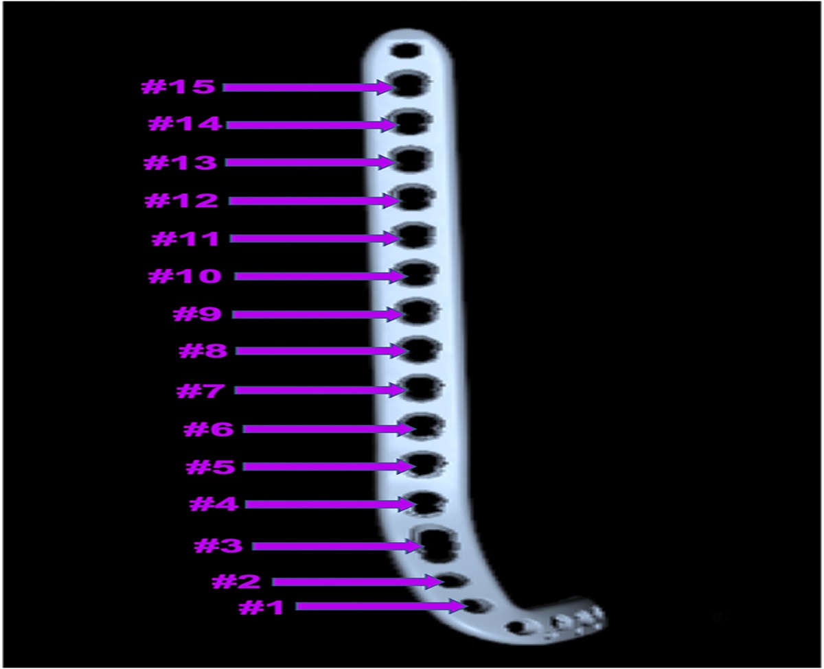 Anterior Tibial Artery Danger Zone During Anterolateral Plate Fixation of the Distal Tibia: A 3D Computed Tomography Angiogram Modeling Study