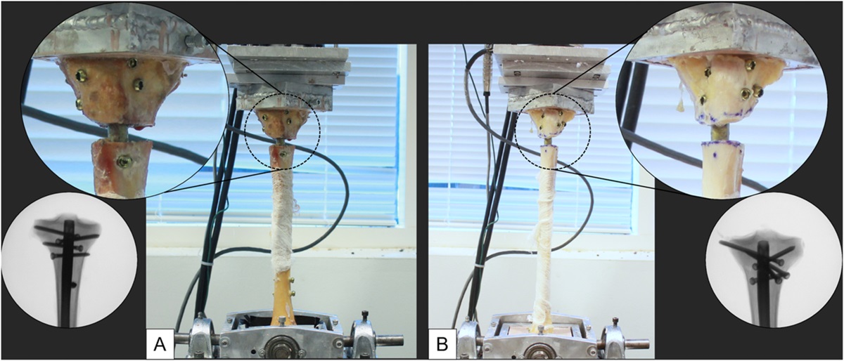 Do Long-Segment Blocking Screws Increase the Stability of Intramedullary Nail Fixation in Proximal Tibia Fractures, Eliminating the “Bell-Clapper Effect?”