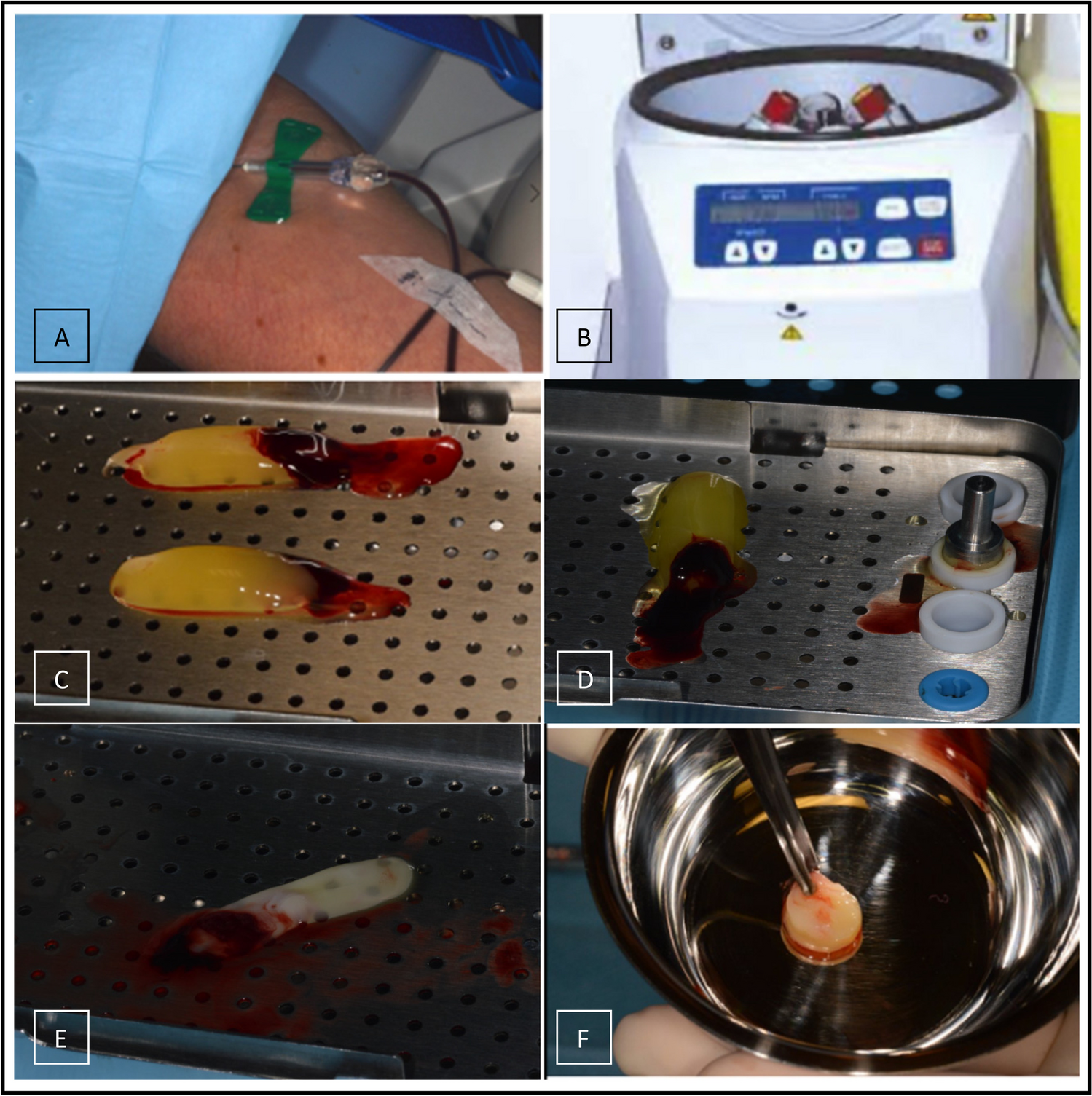 The role of leukocyte and platelet-rich fibrin in the prevention of medication-related osteonecrosis of the jaw, in patients requiring dental extractions: an observational study