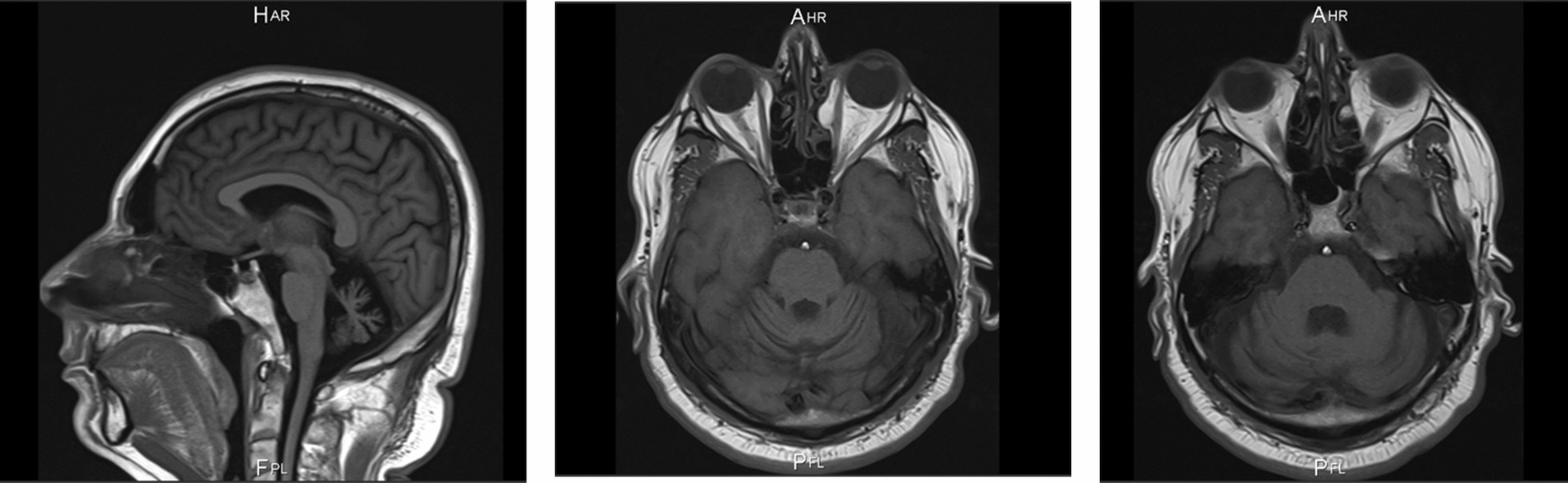 The Phenotypic Spectrum of Spinocerebellar Ataxia Type 19 in a Series of Latin American Patients