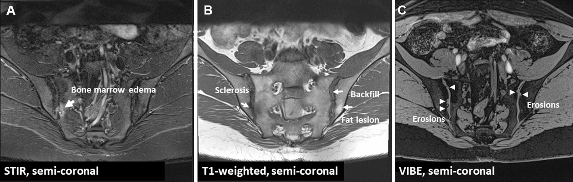 The Role of Early Treatment in the Management of Axial Spondyloarthritis: Challenges and Opportunities
