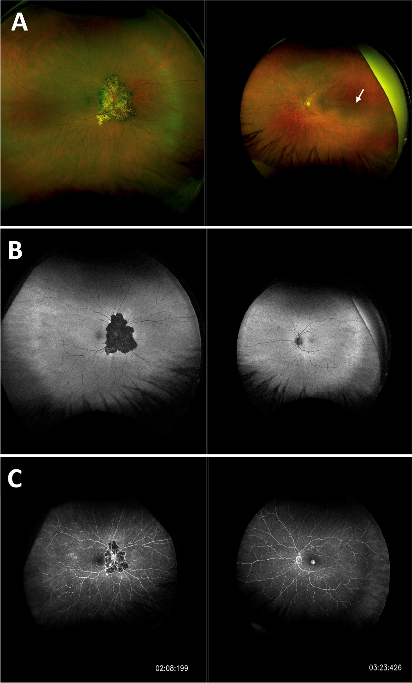 Tuberculosis reactivation demonstrated by choroiditis and inflammatory choroidal neovascular membrane in a patient treated with immune checkpoint inhibitors for malignant mucosal melanoma