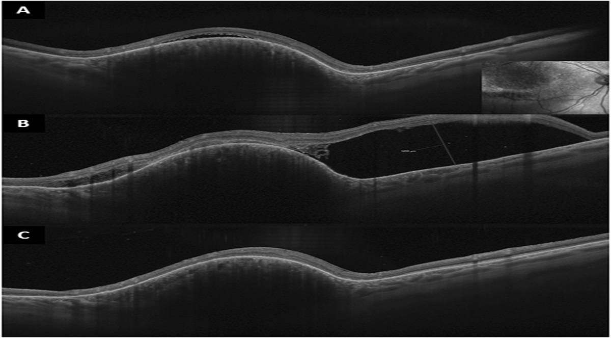 PHOTODYNAMIC THERAPY-INDUCED ACUTE EXUDATIVE MACULOPATHY IN A CASE SERIES OF CIRCUMSCRIBED CHOROIDAL HEMANGIOMA