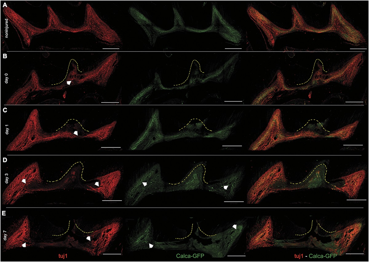 Neuronal–immune axis alters pain and sensory afferent damage during dental pulp injury