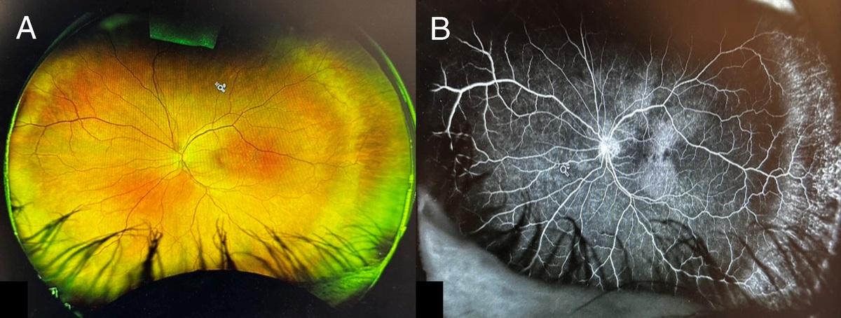 Framboesiform Facial Lesions and Chorioretinopathy as Presenting Signs of Syphilis in an Immunocompetent Patient