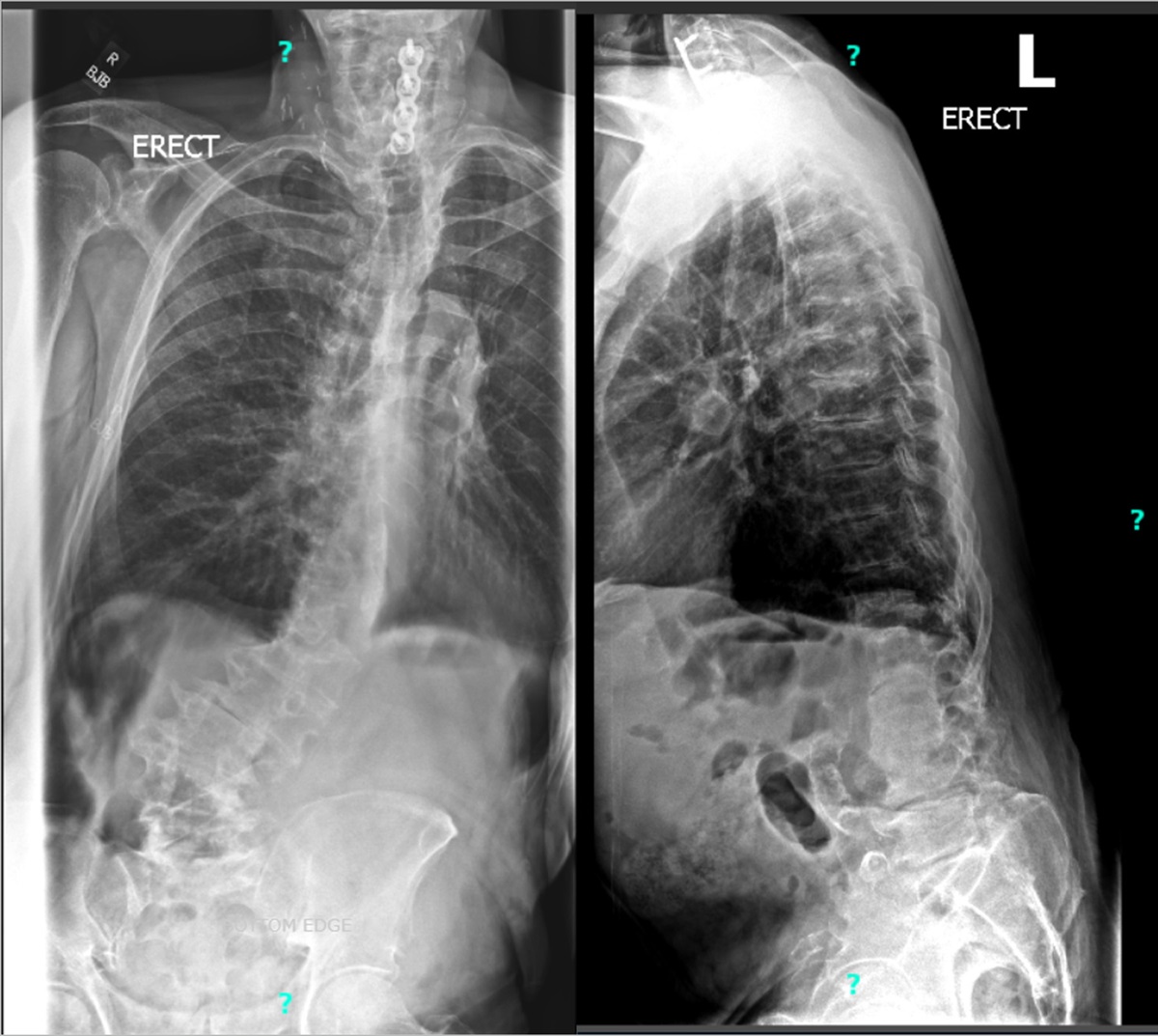 Osteotomy via the prone transpsoas approach for lateral interbody fusion of the lumbar spine
