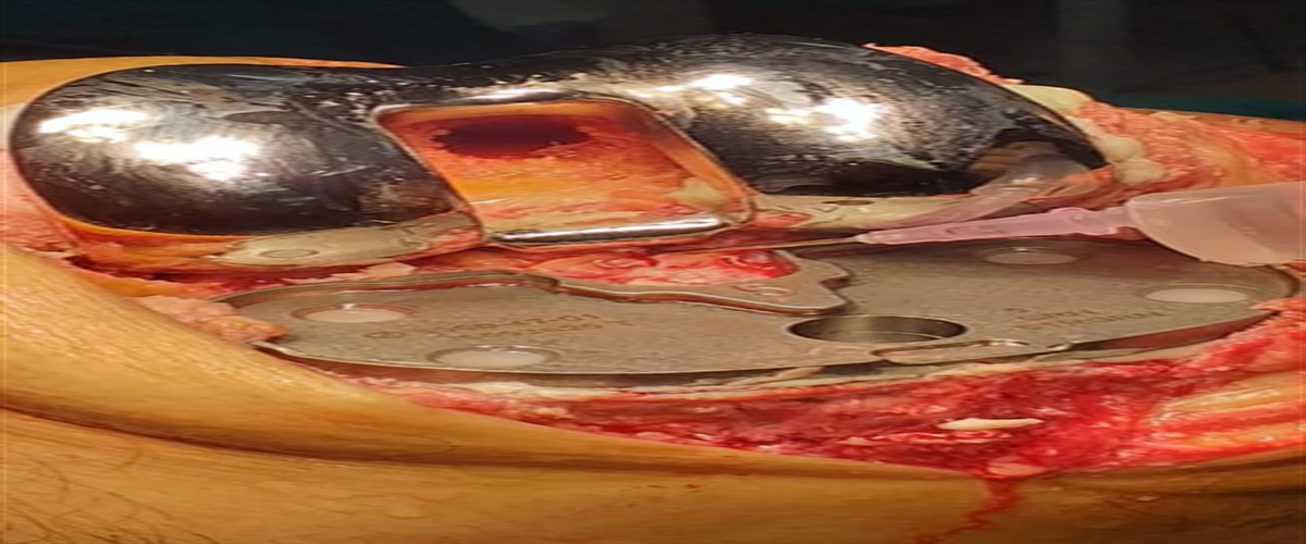 Platelet rich plasma could replace tranexemic acid in total knee replacement? A comparative study between their postoperative- bleeding hemostatic effects