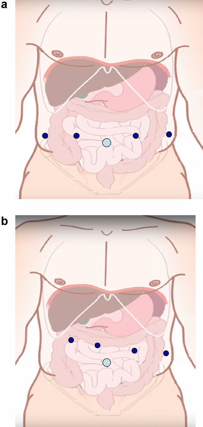 Robotic Pancreatic Surgery: Current Status and Techniques