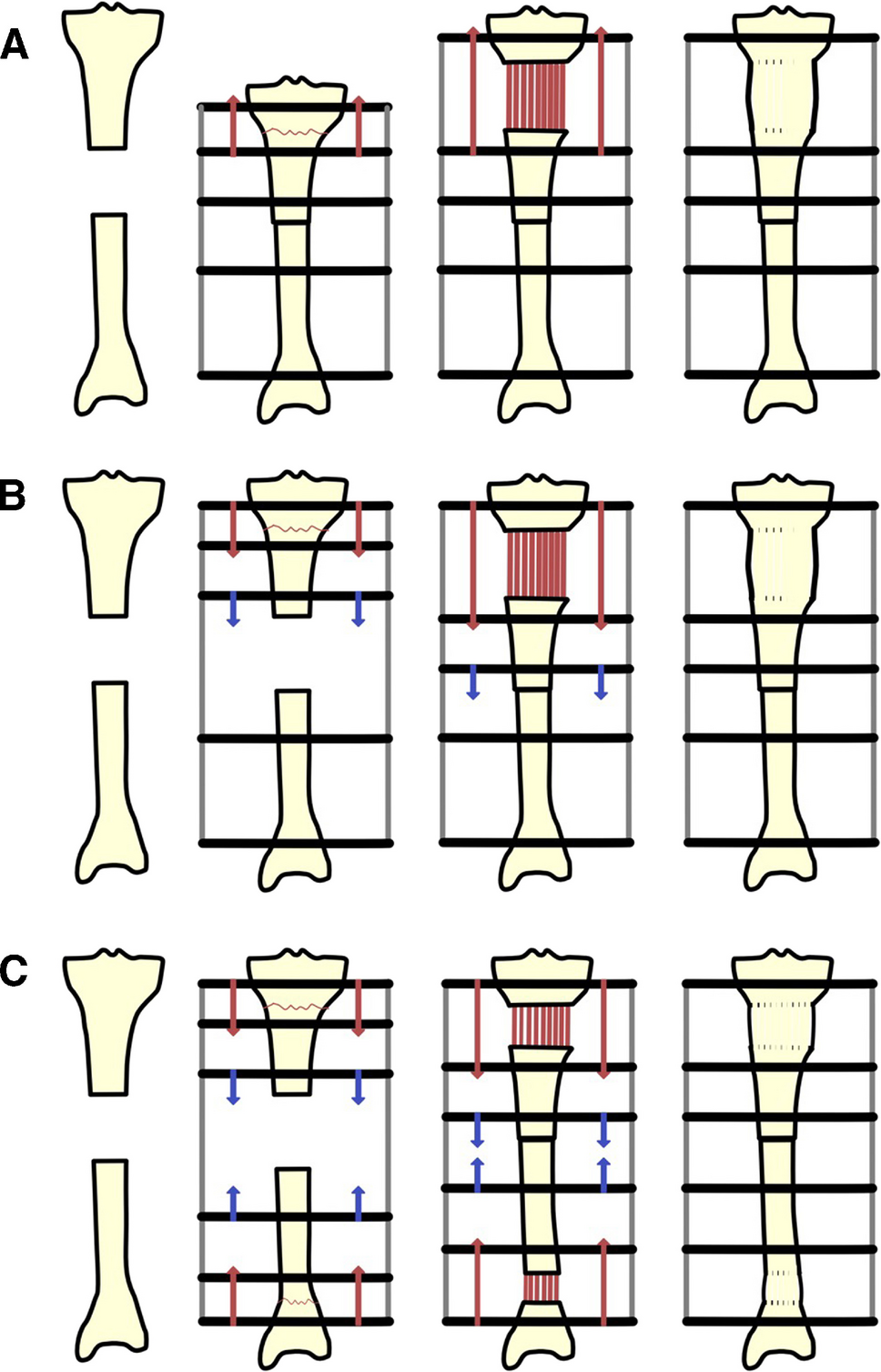Docking site interventions following bone transport using external fixation: a systematic review of the literature