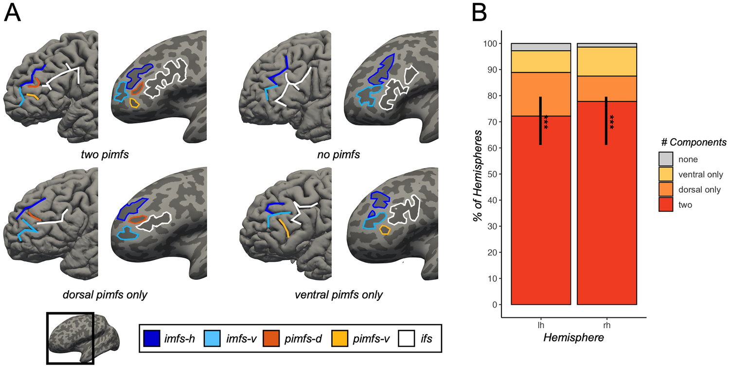 Sulcal variability in anterior lateral prefrontal cortex contributes to variability in reasoning performance among young adults