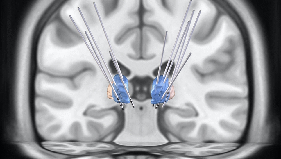 Somatotopic organization of the ventral nuclear group of the dorsal thalamus: deep brain stimulation for neuropathic pain reveals new insights into the facial homunculus