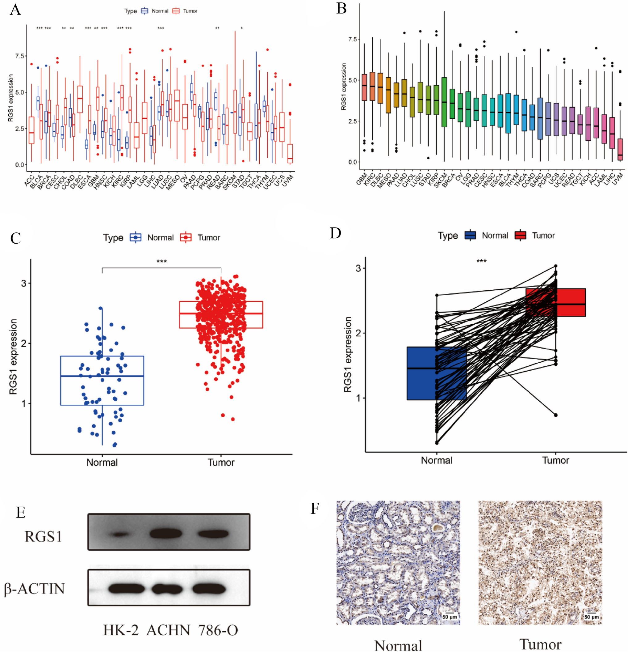 Regulator of G protein signaling-1 regulates immune infiltration and macrophage polarization in clear cell renal cell carcinoma