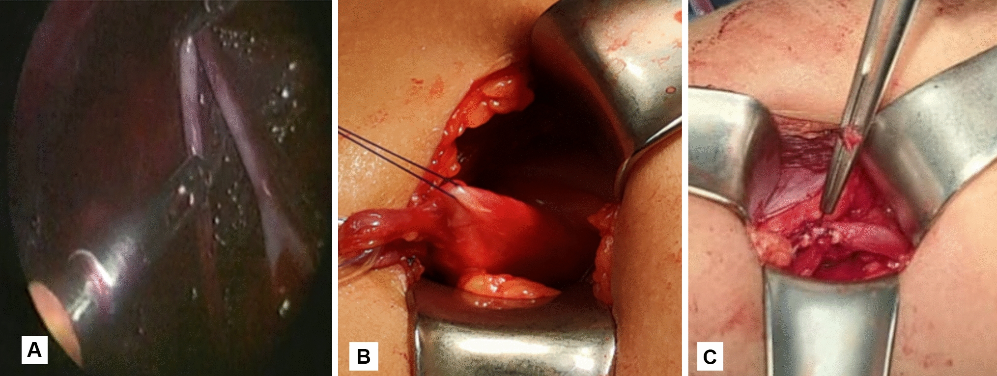 Laparoscopic assisted dismembered pyeloplasty versus open pyeloplasty in UPJO with poorly function kidney in pediatrics