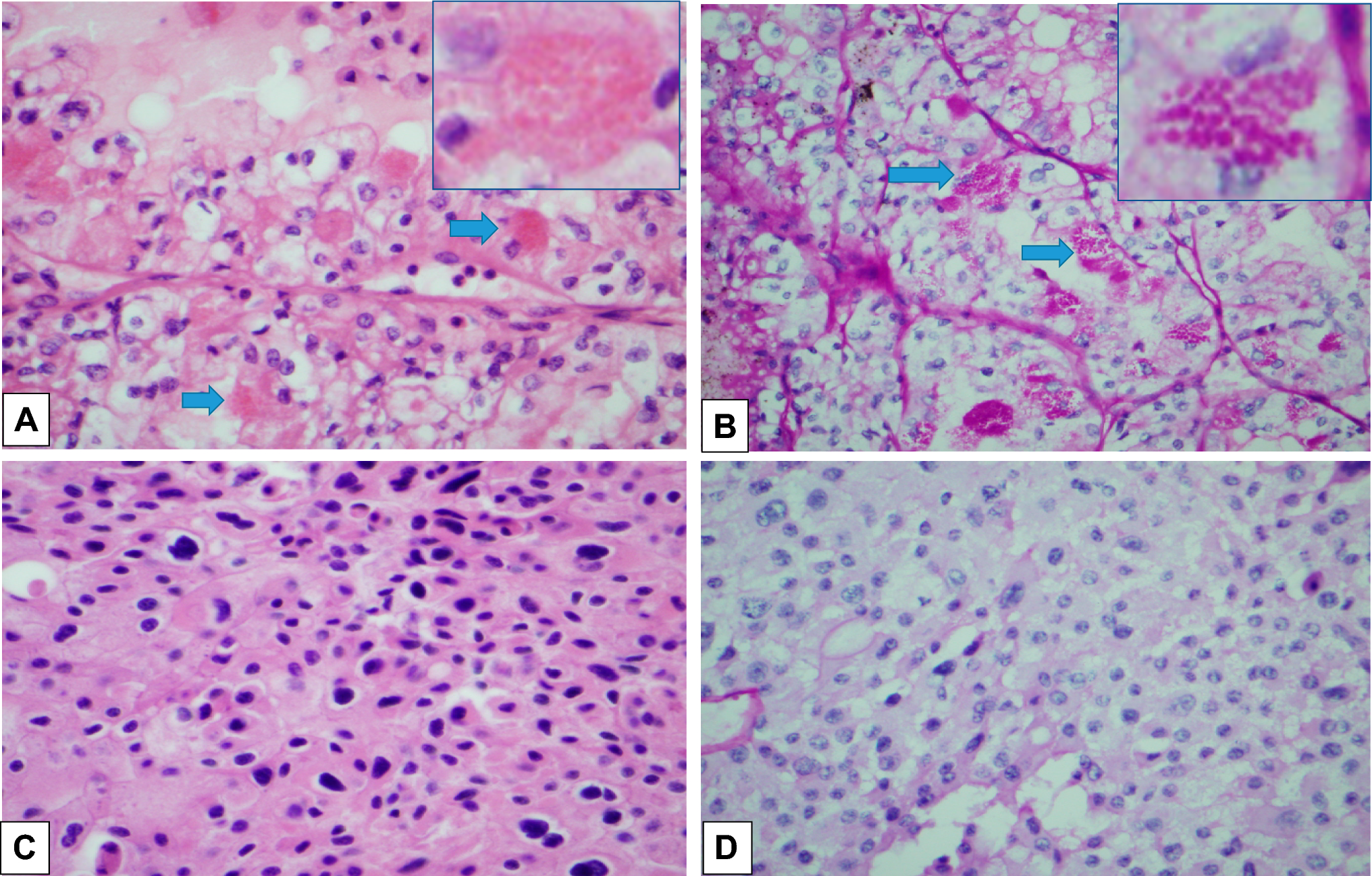 Clear cell renal cell carcinoma cells show diffuse expression of phagocytotic markers through the identification of lysosome-rich eosinophilic granules
