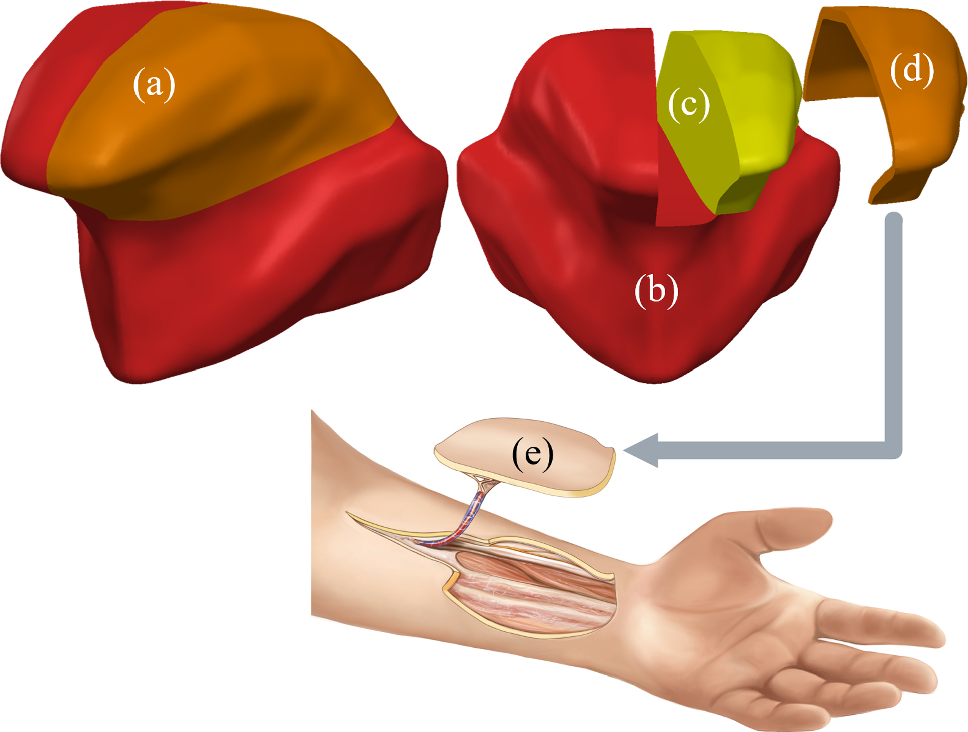 Algorithmically designed flaps in tongue reconstruction: a feasibility analysis
