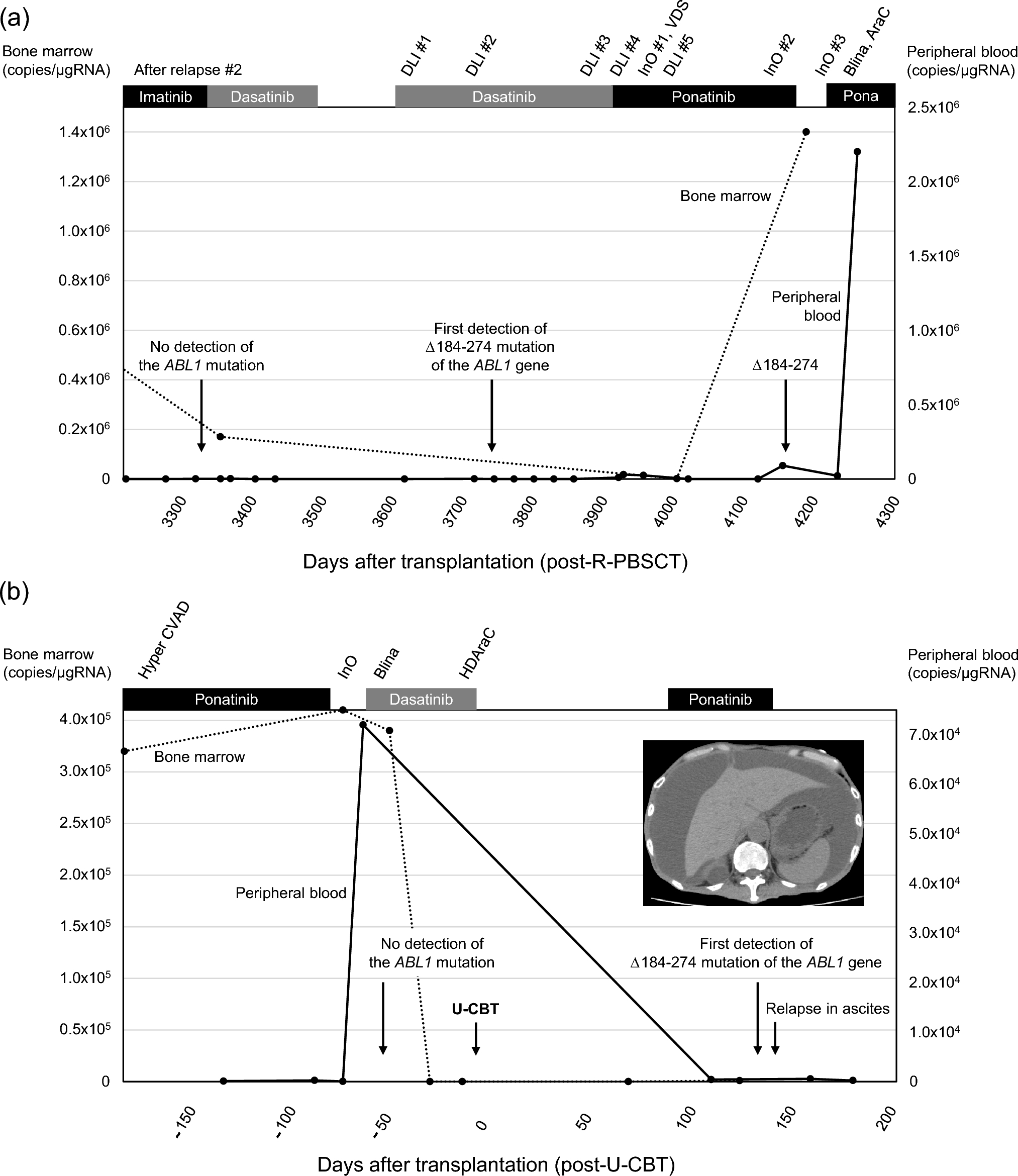 A case report of a truncated ABL1 mutation in 2 cases with Philadelphia chromosome-positive B cell precursor acute lymphoblastic leukemia