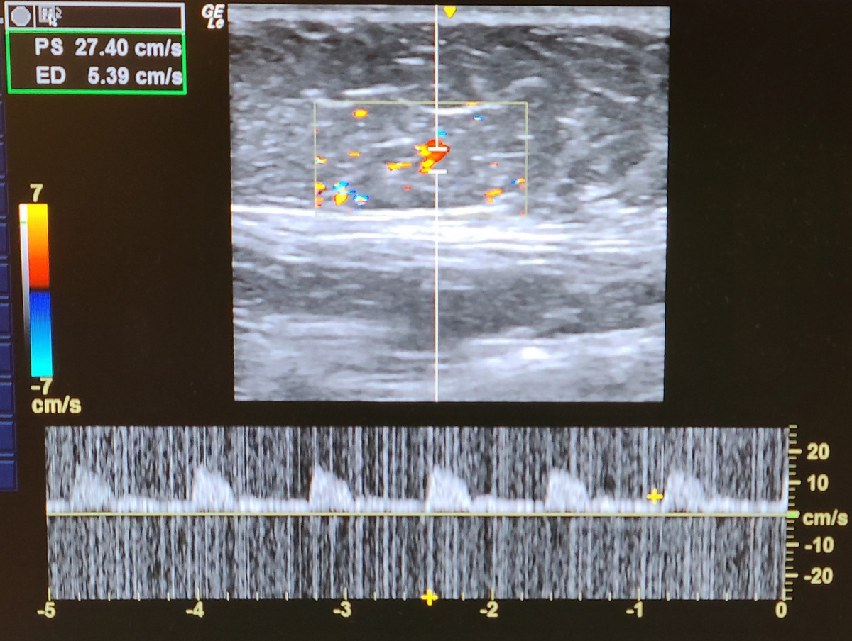 Surgical Delay of Thoracodorsal Artery Perforator Flaps for Total Autologous Breast Reconstruction