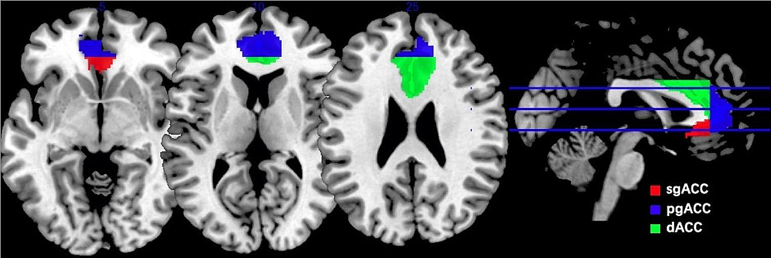 Distinct resting-state functional connectivity of the anterior cingulate cortex subregions in first-episode schizophrenia