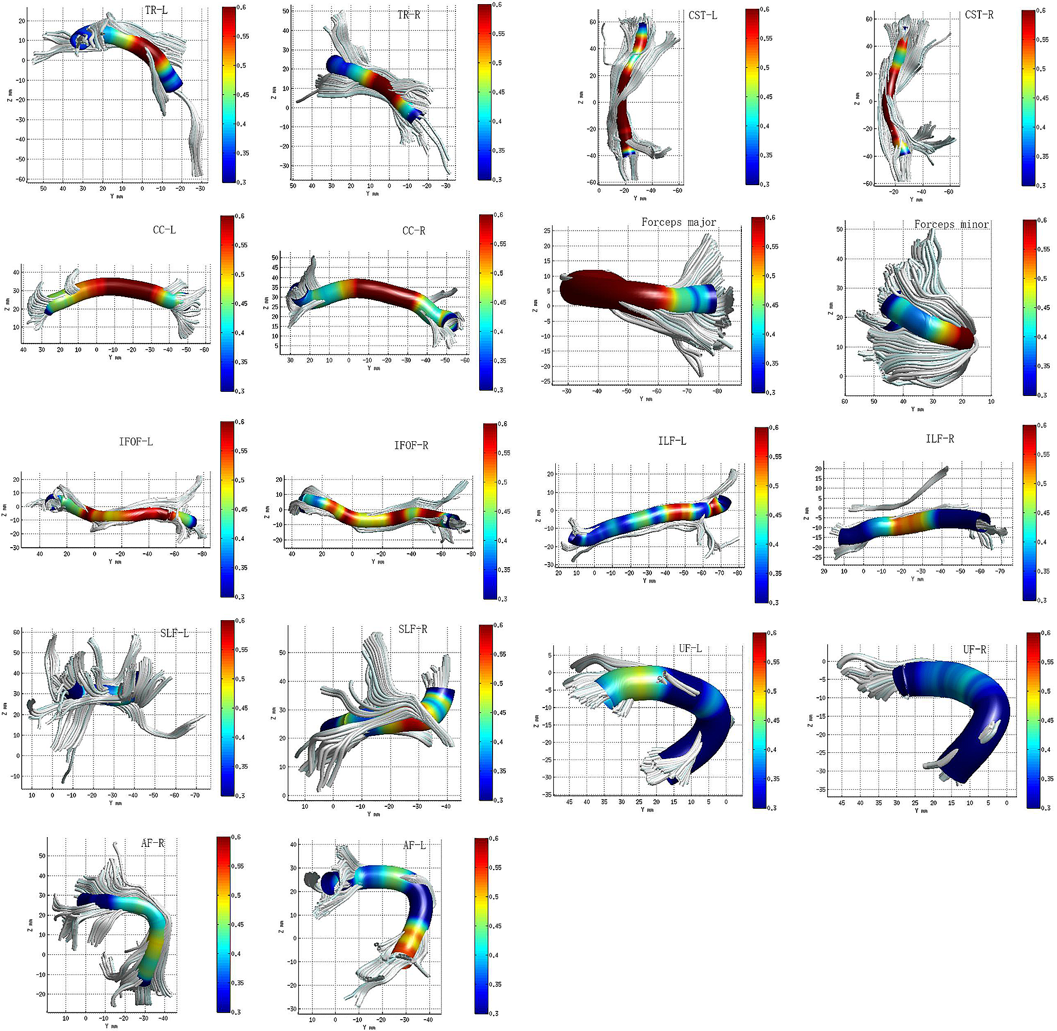 Brain white matter microstructural alterations in patients with systemic lupus erythematosus: an automated fiber quantification study