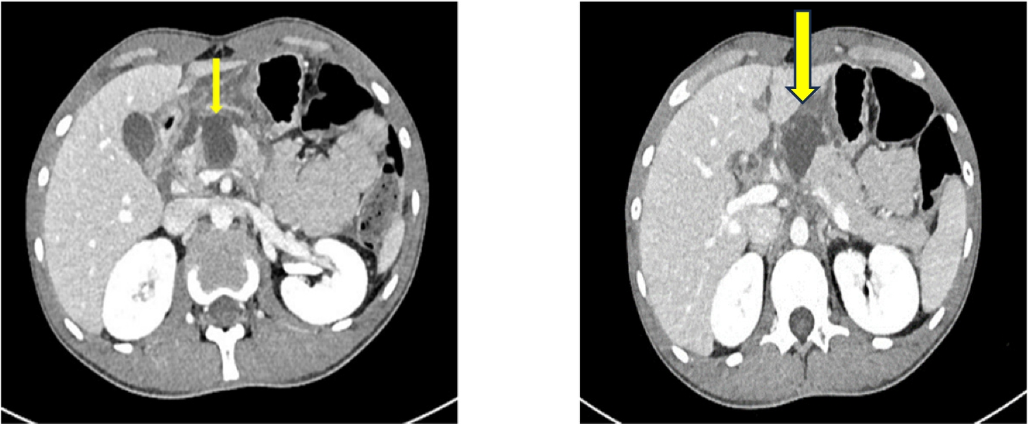 Open Pancreatic Duct Stenting in Pancreatic Trauma: A Bridge in the Path of Pancreatic Preservation