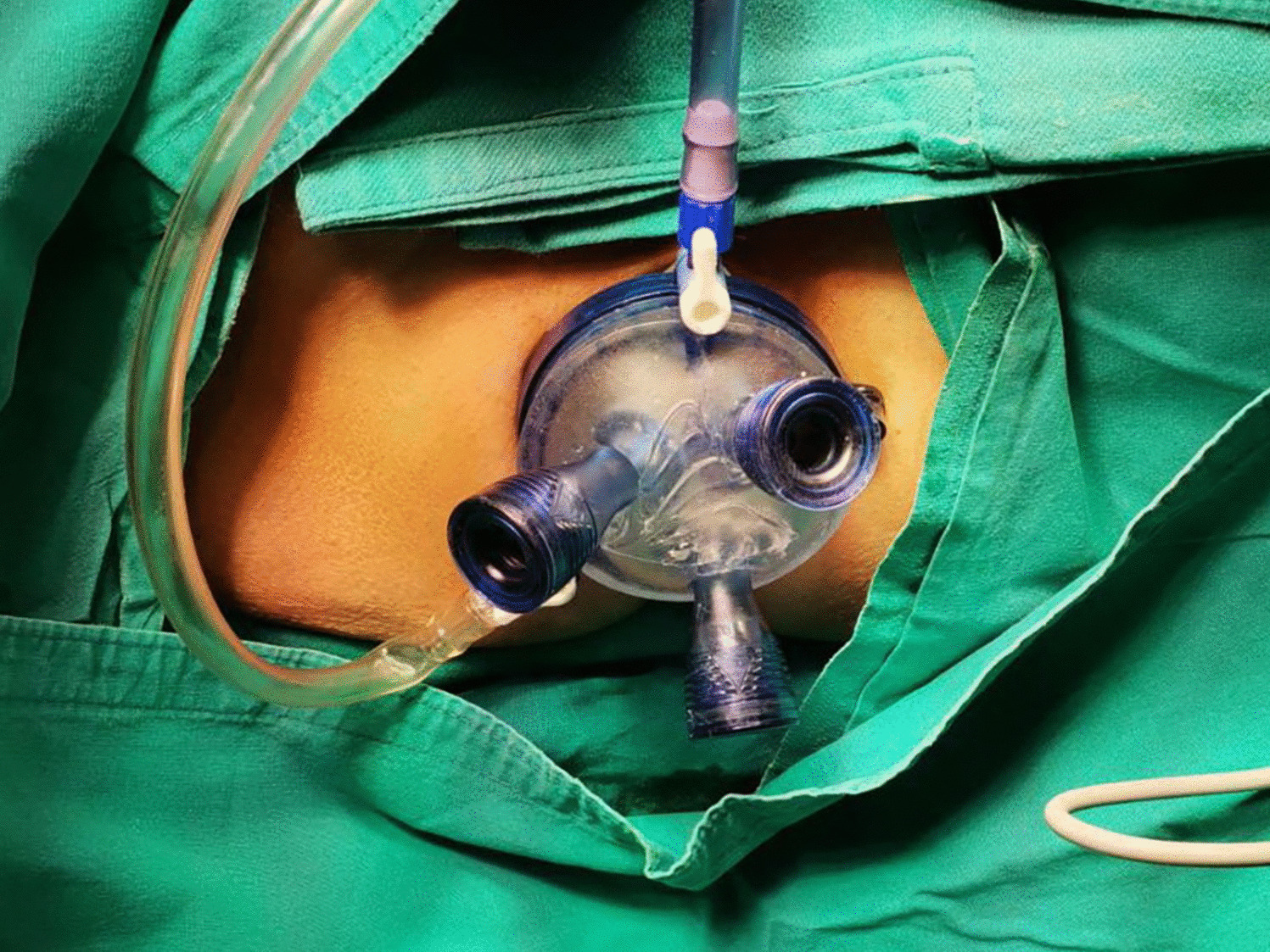 Transanal Minimally Invasive Surgery in the Treatment of Large Polyps and Early Rectal Carcinoma
