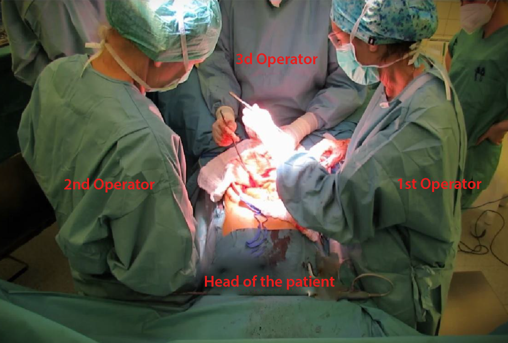 The Kock pouch (continent ileostomy)