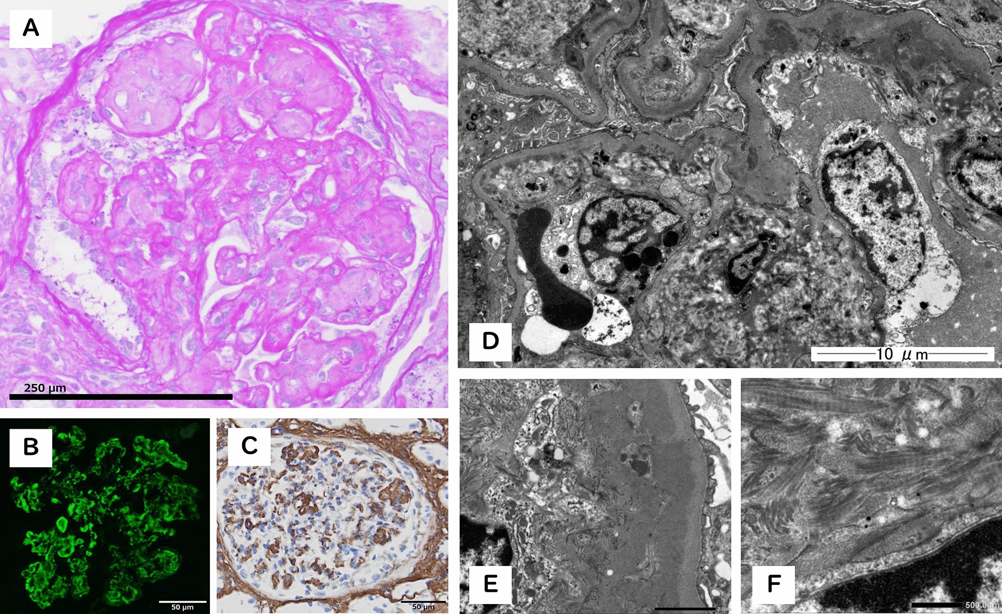 Rapidly progressive glomerulonephritis due to IgA nephropathy accompanied by collagenofibrotic glomerulopathy. A nephrology picture