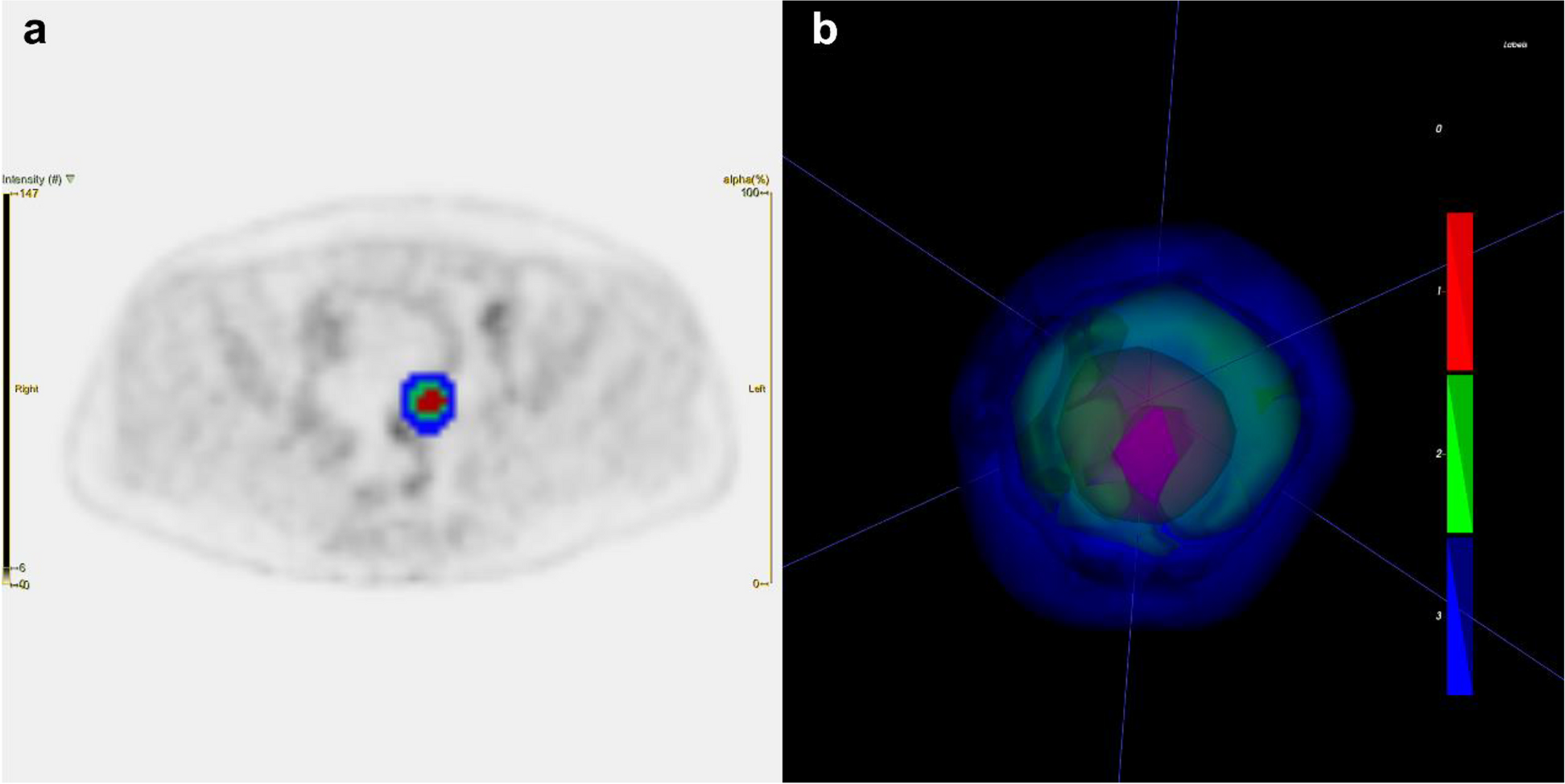 Using tumor habitat-derived radiomic analysis during pretreatment 18F-FDG PET for predicting KRAS/NRAS/BRAF mutations in colorectal cancer