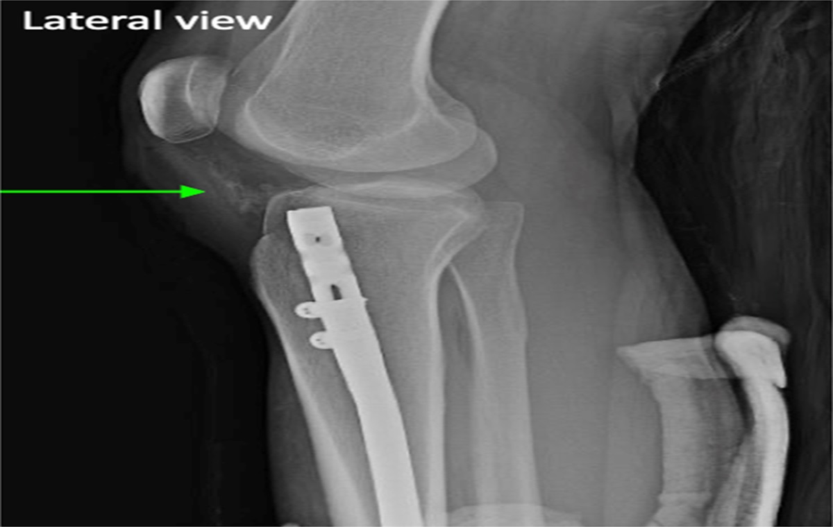 Incidence and Risk Factors of Heterotopic Ossification in the Knee After Reamed Tibial Nailing