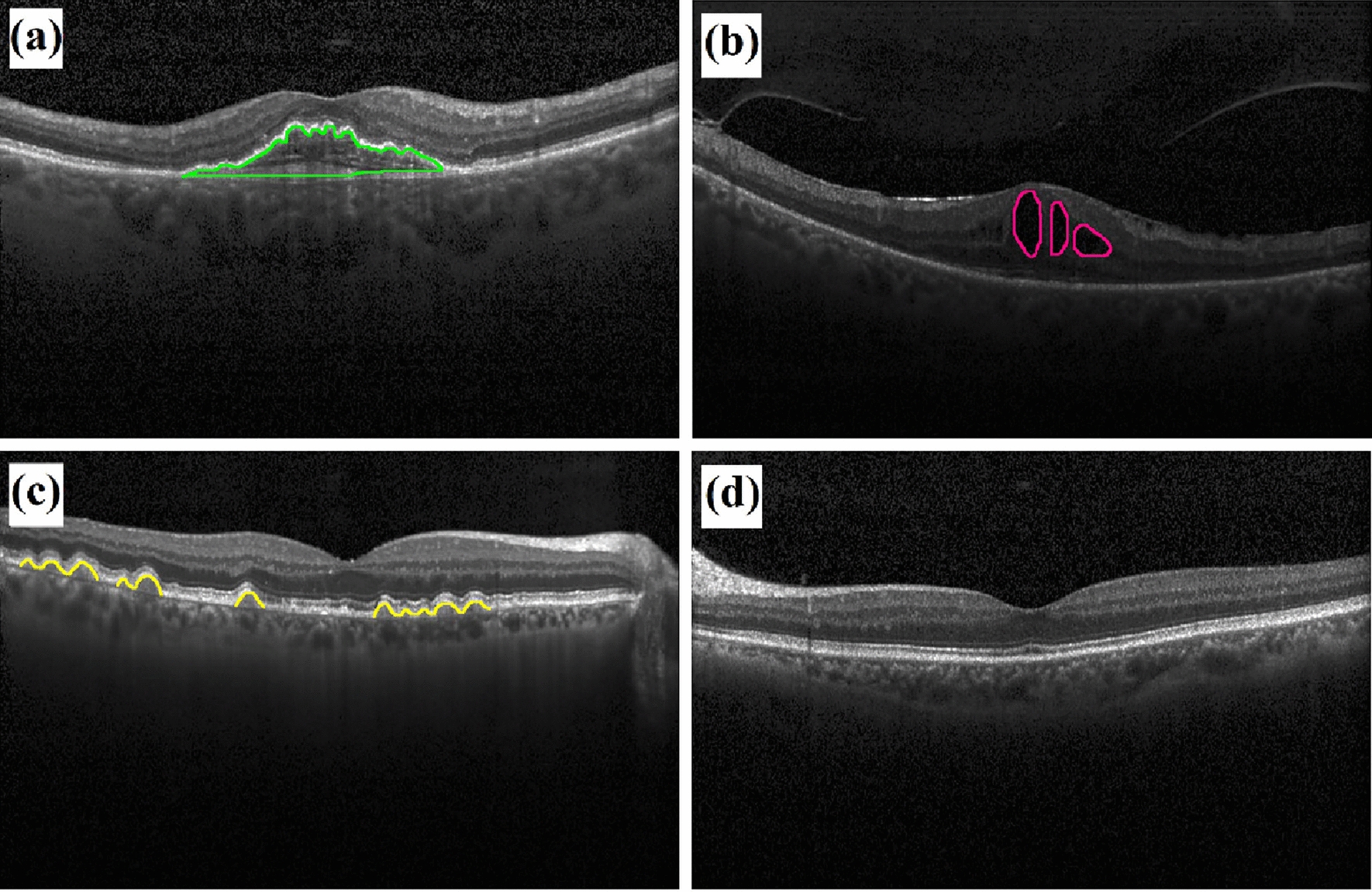 A new computer-aided diagnosis tool based on deep learning methods for automatic detection of retinal disorders from OCT images