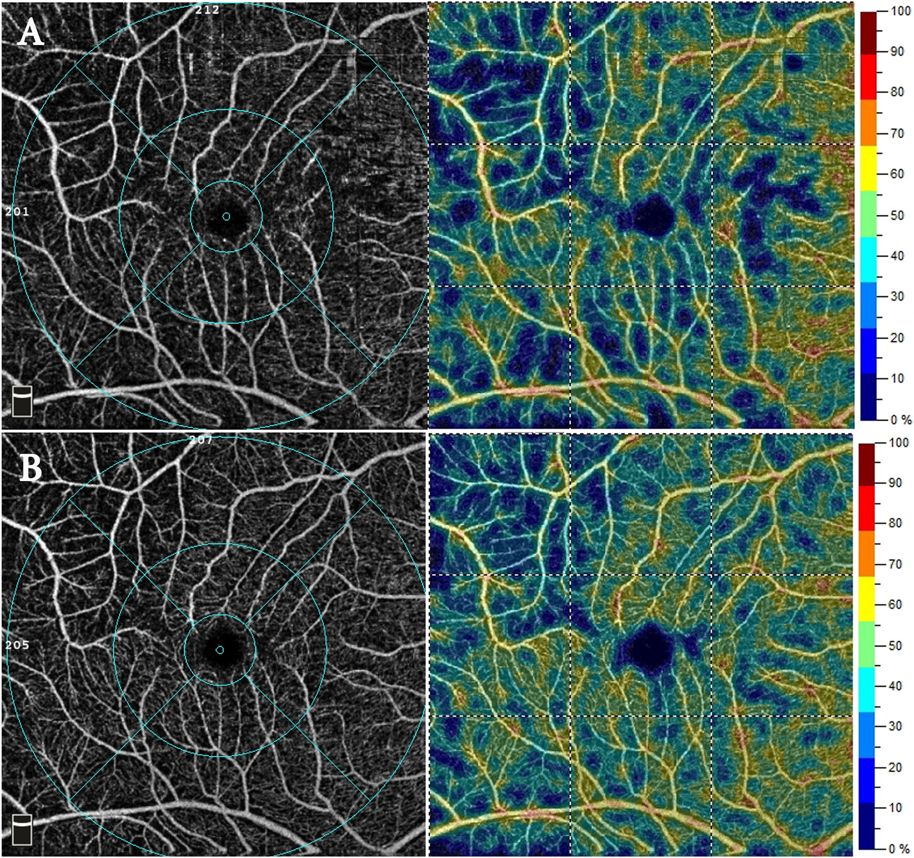 Functional and perfusion changes associated with silicone oil tamponade after macula-off rhegmatogenous retinal detachment surgery: an optical coherence tomography angiography/microperimetry study